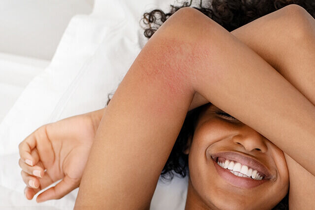 Ein Frau mit zu Neurodermitis, Ekzemen neigender Haut am Oberarm, nahe des Ellenbogens, liegt lächelnd mit verschränkten Armen auf dem Bett.