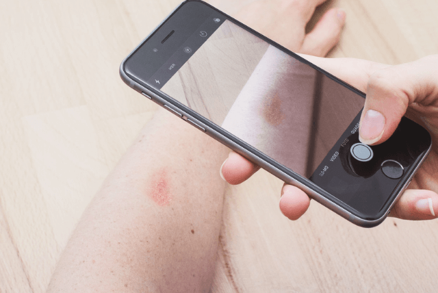 Person hält Smartphone und macht Foto von Hautproblem