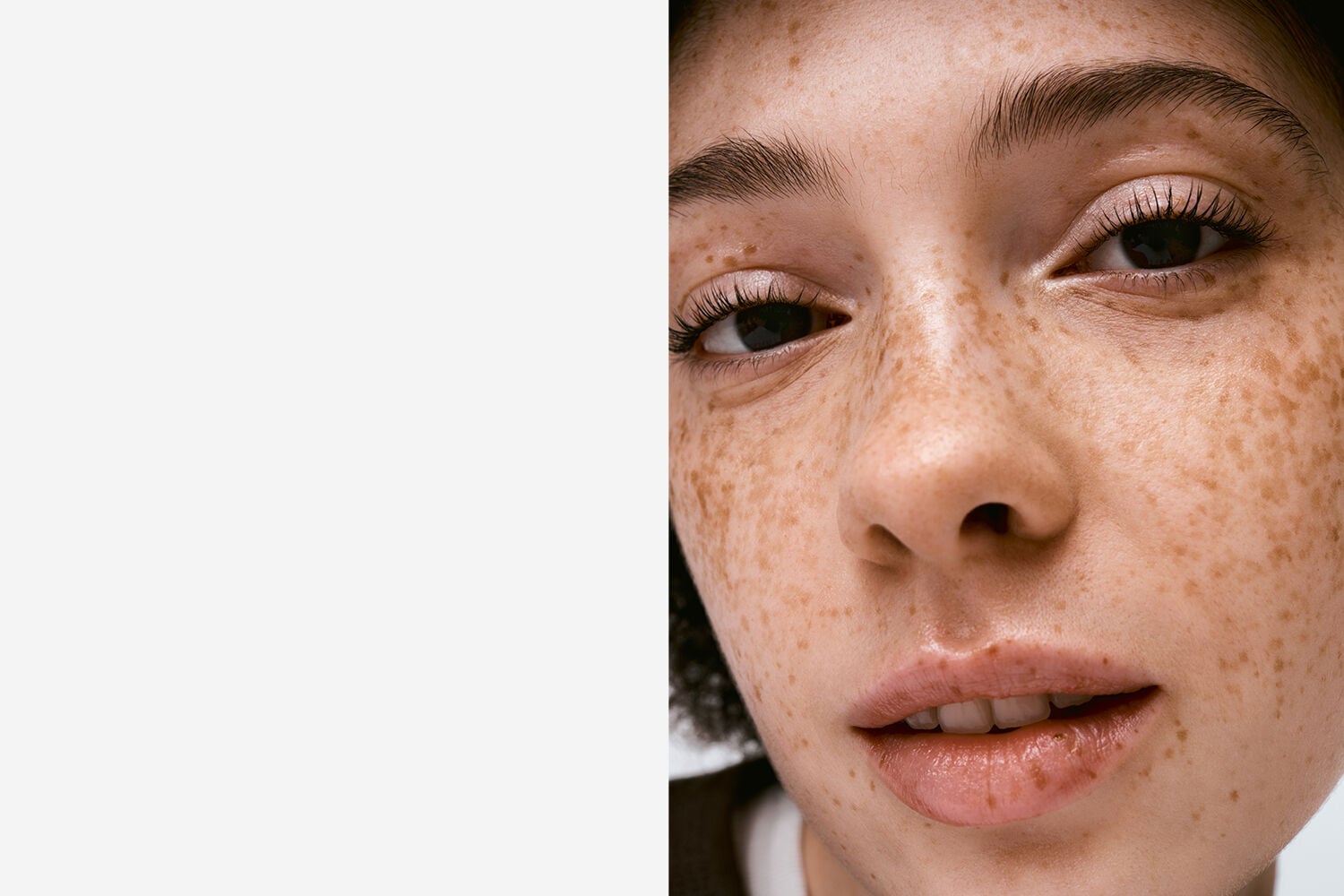 acne